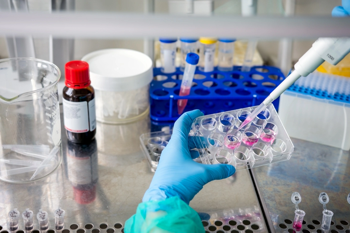 Cellules cancéreuses ovariennes observées au microscope en laboratoire