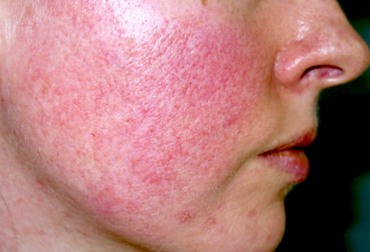 Understanding Rosacea: A Simple Guide