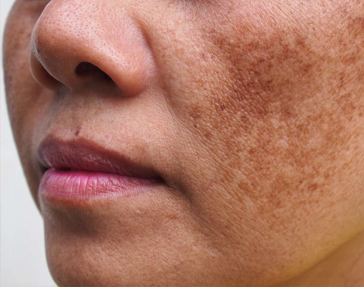 What is Melasma? | Liverpool | Formby | Aughton | Maghull | Ormskirk