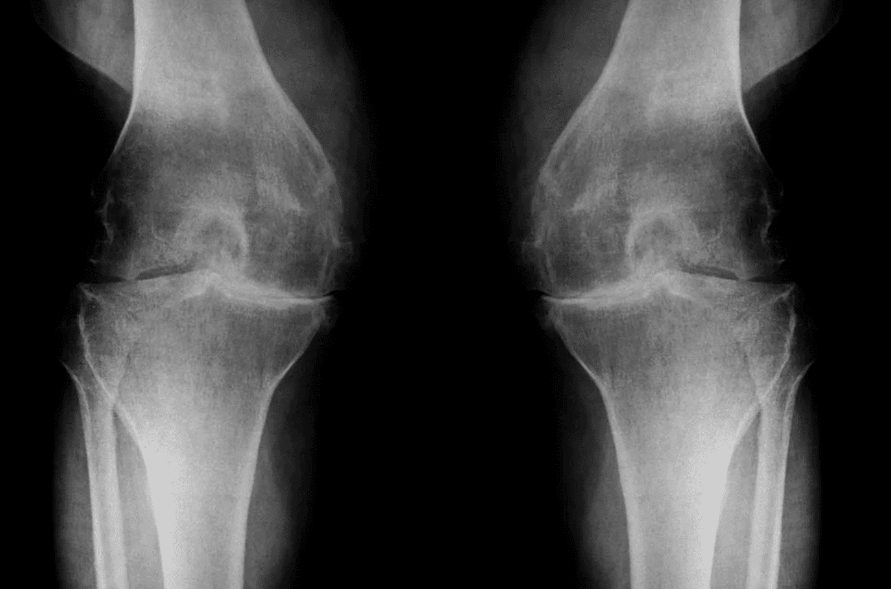 ¿Qué es la artrosis?