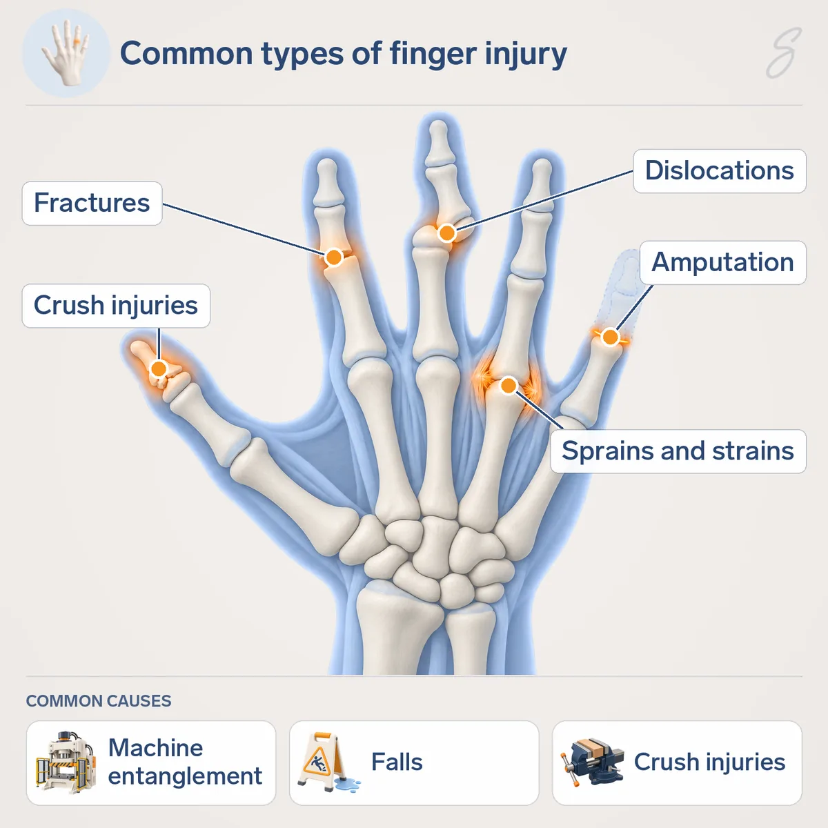 Diagram of a hand seen from the back with one injury on each digit: a fracture, a dislocation, a sprain, a crush injury and an amputation level. Common causes shown are machine entanglement, falls and crush injuries.