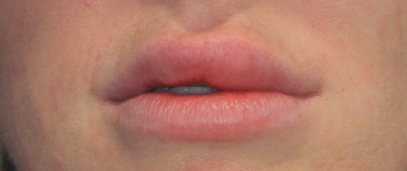 Photo of patient’s lips when she arrived at the clinic.