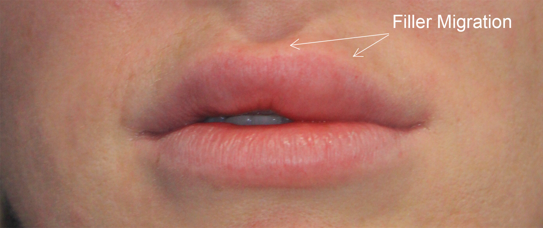 Note the slight contour difference in the white part of the lip where the filler has migrated. 