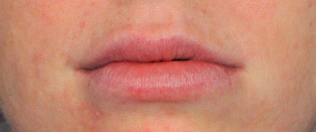 Patient’s lip 2 weeks post hyaluronidase injection. Some filler was purposely left in her upper right lip hence the size discrepancy.