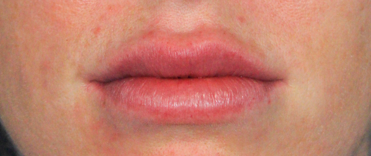 Patient’s lips after a touch up with half a syringe of Restylane Kysse. What looks like migration superior to the vermillion border is just some post-procedural swelling. 