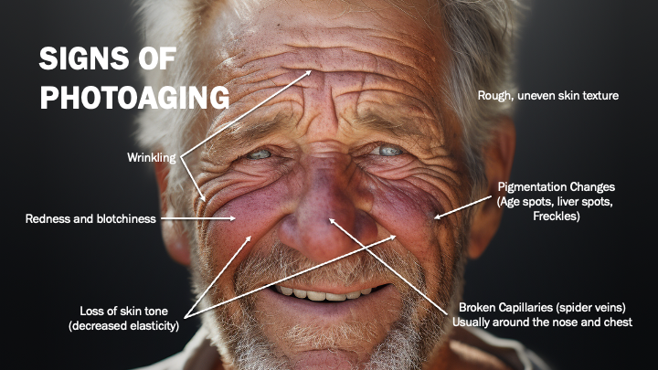 Diagram showing the signs of photoaging on an older man.