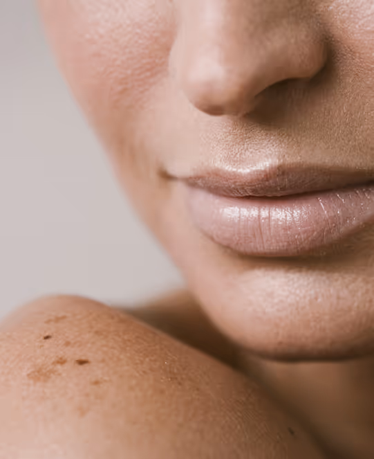 NeoGen PSR – Plasma Skin Regeneration Treatment