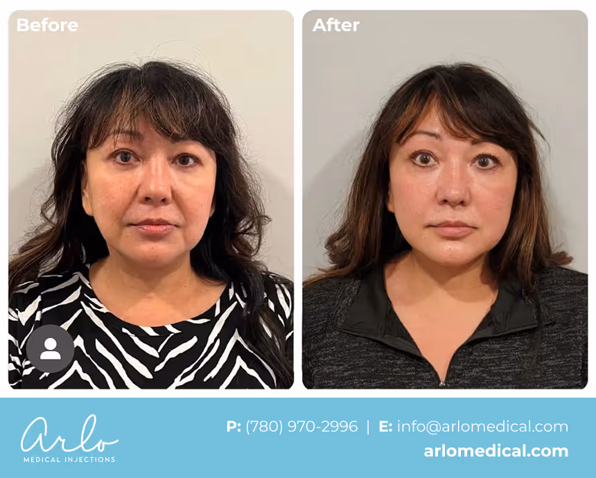 NeoGen PSR – Plasma Skin Regeneration Treatment Before & After