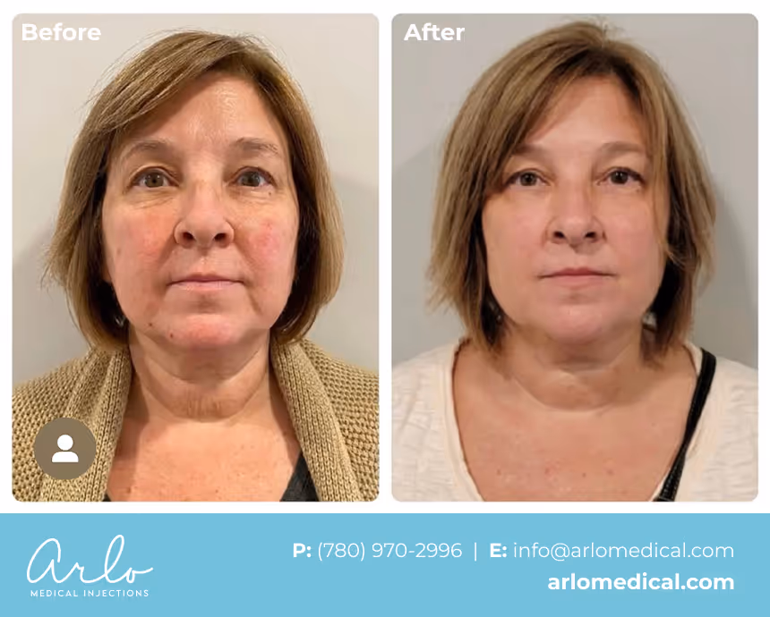 NeoGen PSR – Plasma Skin Regeneration Treatment Before & After