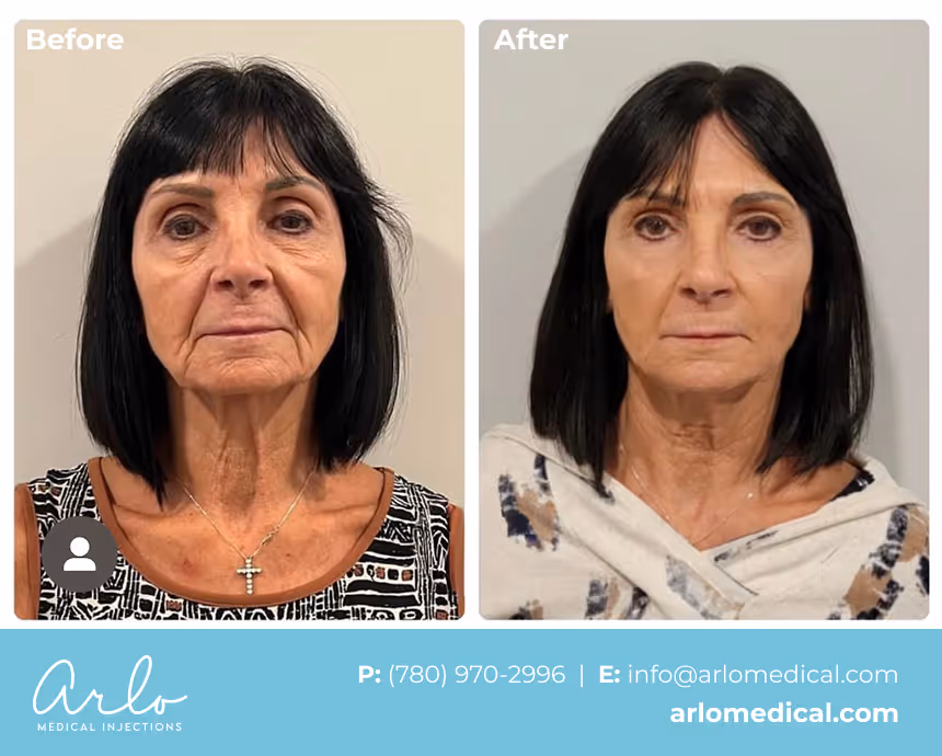 NeoGen PSR – Plasma Skin Regeneration Treatment Before & After