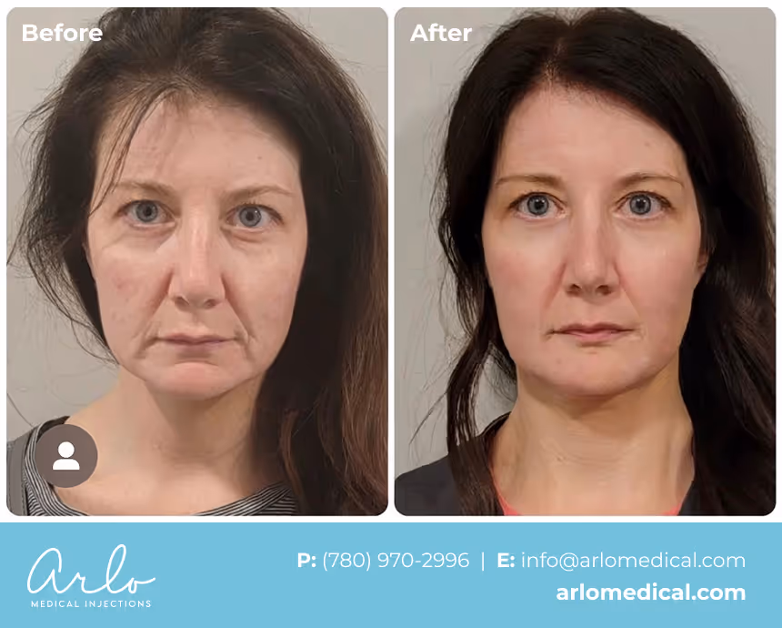 NeoGen PSR – Plasma Skin Regeneration Treatment Before & After