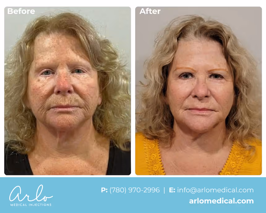 NeoGen PSR – Plasma Skin Regeneration Treatment Before & After