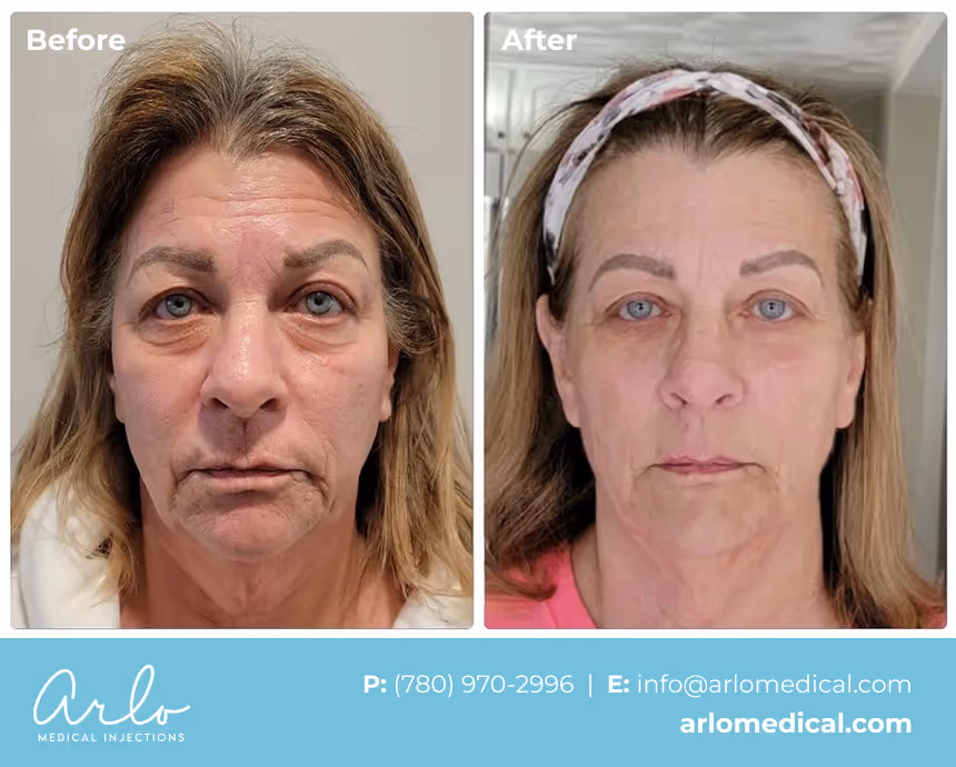 NeoGen PSR – Plasma Skin Regeneration Treatment Before & After