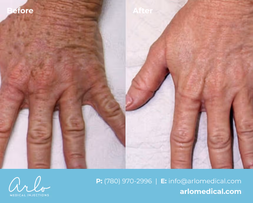 NeoGen PSR – Plasma Skin Regeneration Treatment Before & After