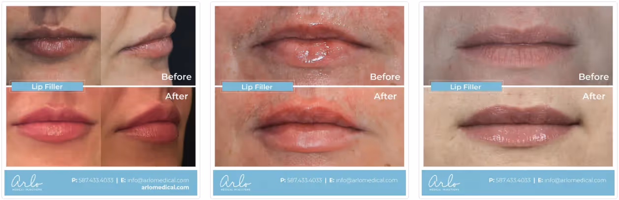 Dermal fillers before and after photos