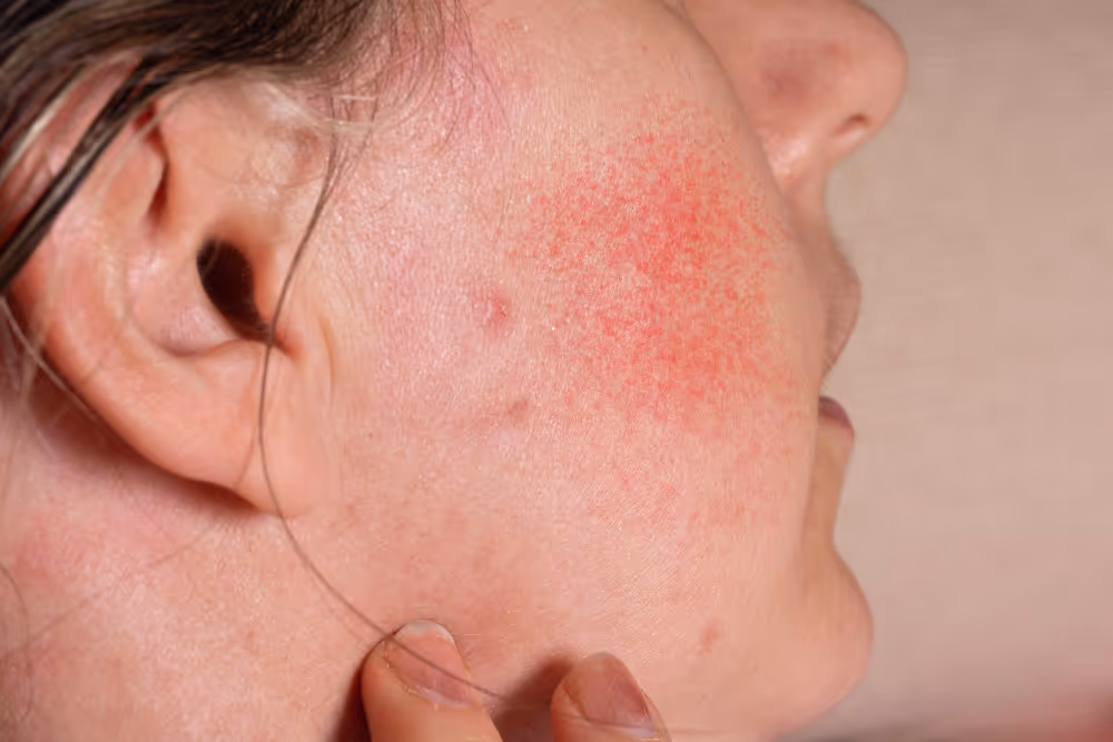 Rosacea Management