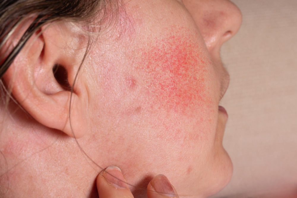 Rosacea Management