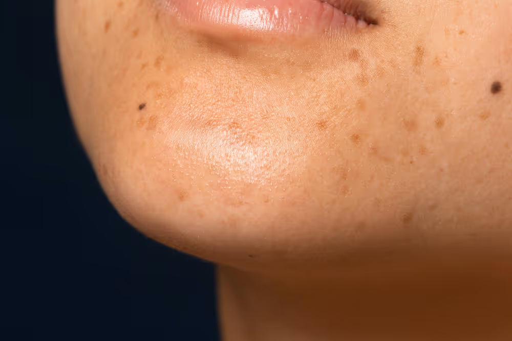 Hyperpigmentation Solutions