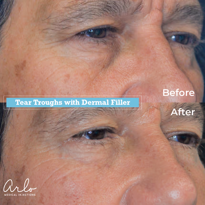 Tear Trough Before & After