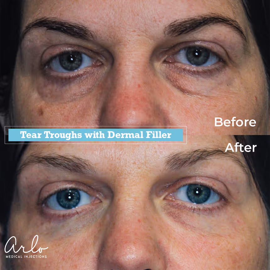 Tear Trough Before & After