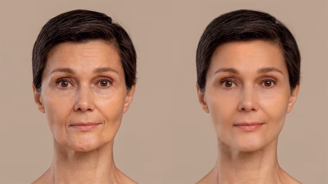 Botox vs Dysport: What's the Difference and Which Is Right for You?