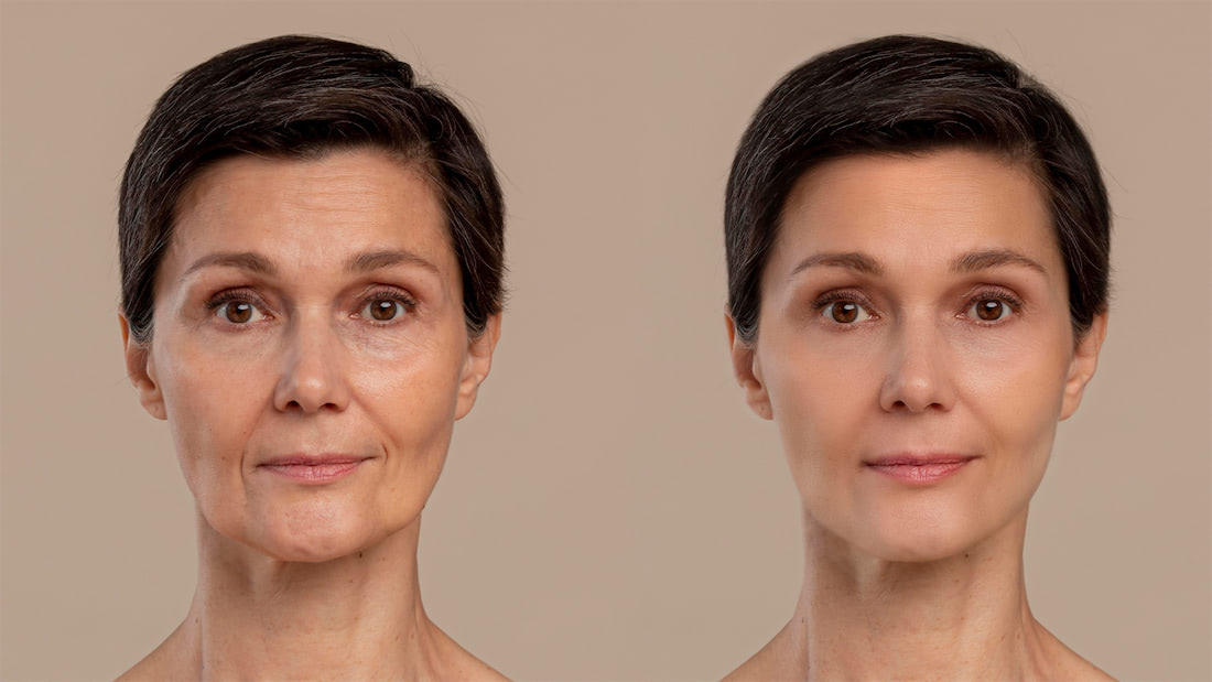 Botox vs Dysport: What's the Difference and Which Is Right for You?