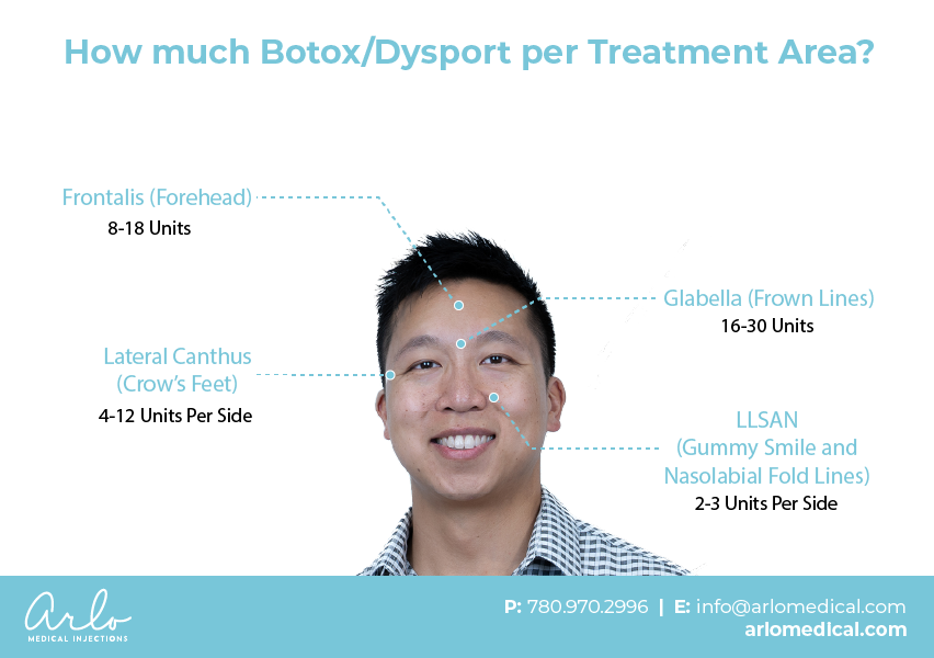 Diagram showing how much Botox/Dysport per treatment area on a man.