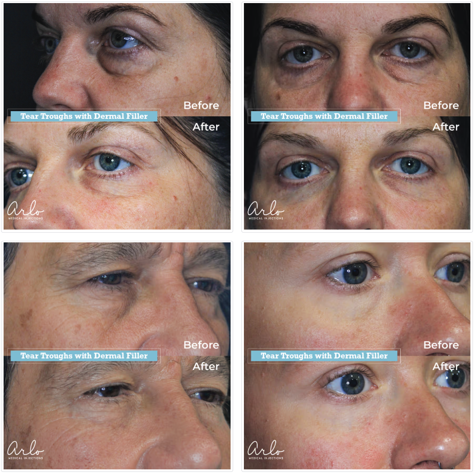 Dermal Fillers Before & After