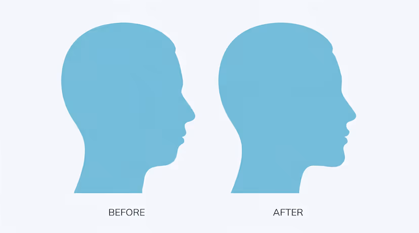 Side-by-side profile silhouette showing chin projection improvement.