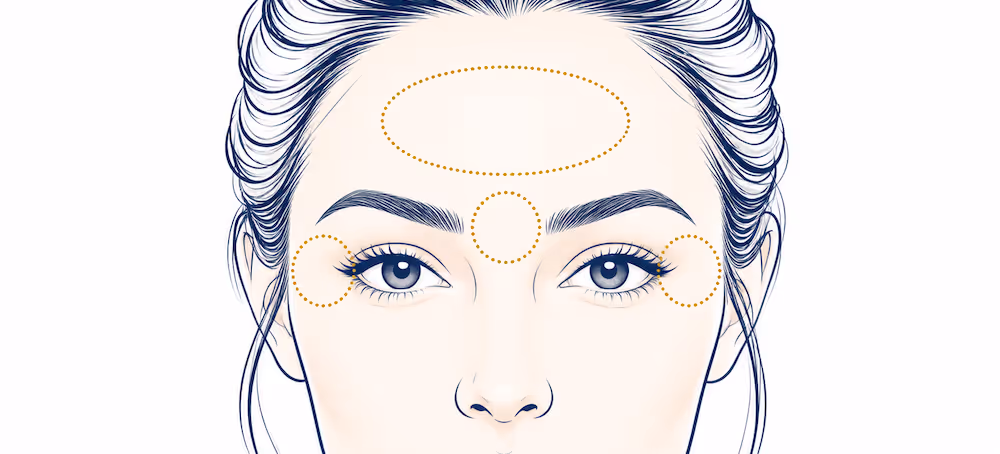 Minimalist face diagram with dotted circles on treatment zones