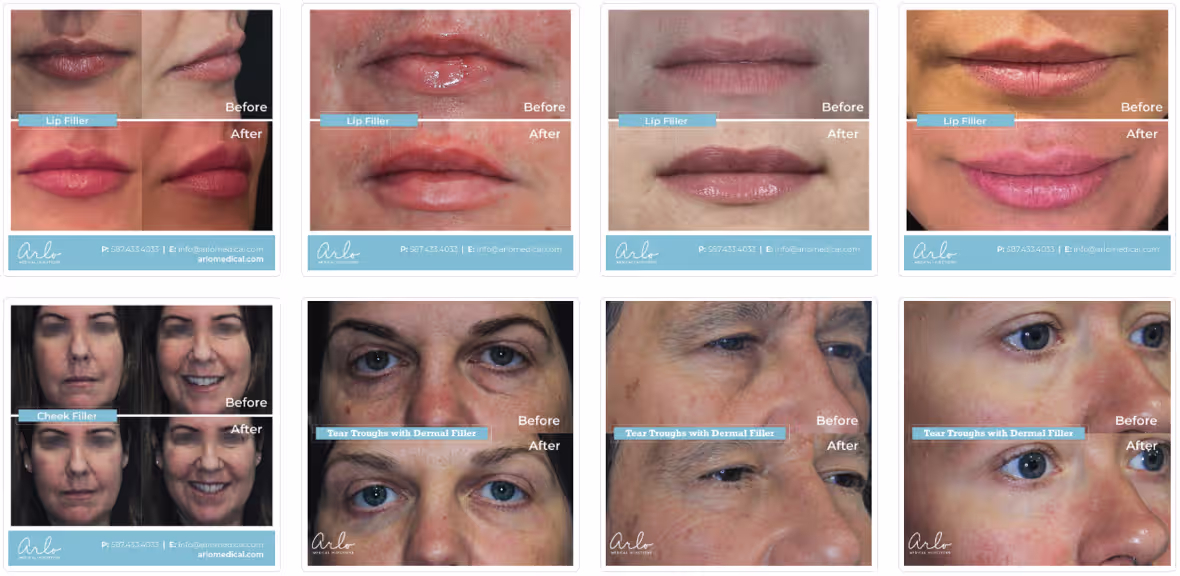 Lip Filler - Beore & After Photos from our patients