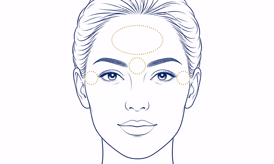 Botox Treatment Area Diagram