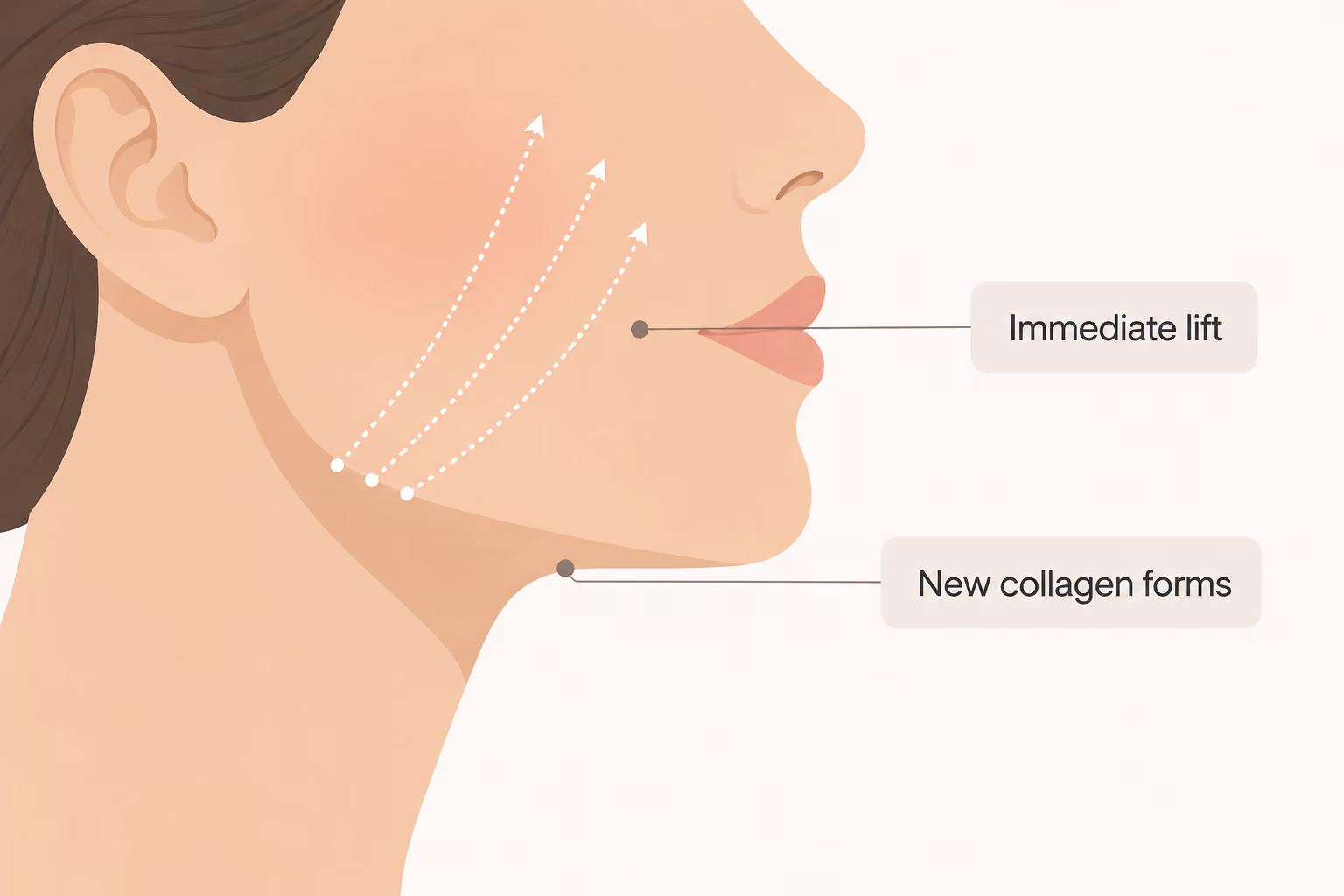 Diagram - How a PDO thread lift lifts the face and stimulates collagen