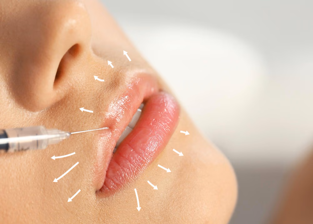 Lip Filler