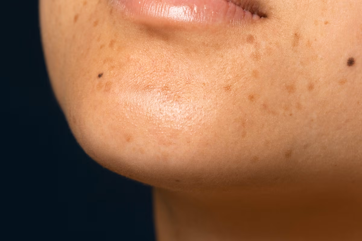Dark Spots and Hyperpigmentation: Why They Happen and What Actually Helps
