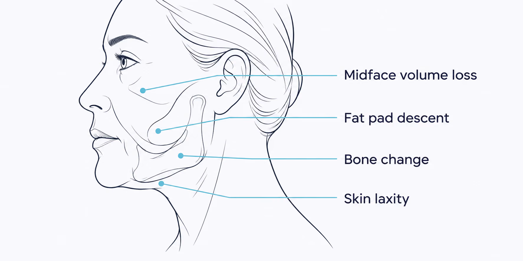 Diagram showing the four causes of jowls: midface volume loss, fat pad descent, bone change, and skin laxity.