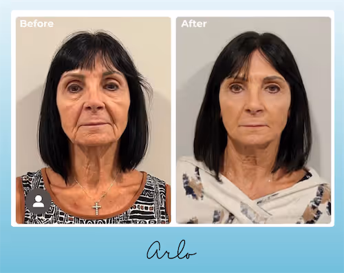 Before and after treatment with NeoGen PSR