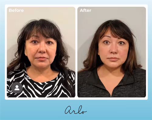 Before and after treatment with NeoGen PSR