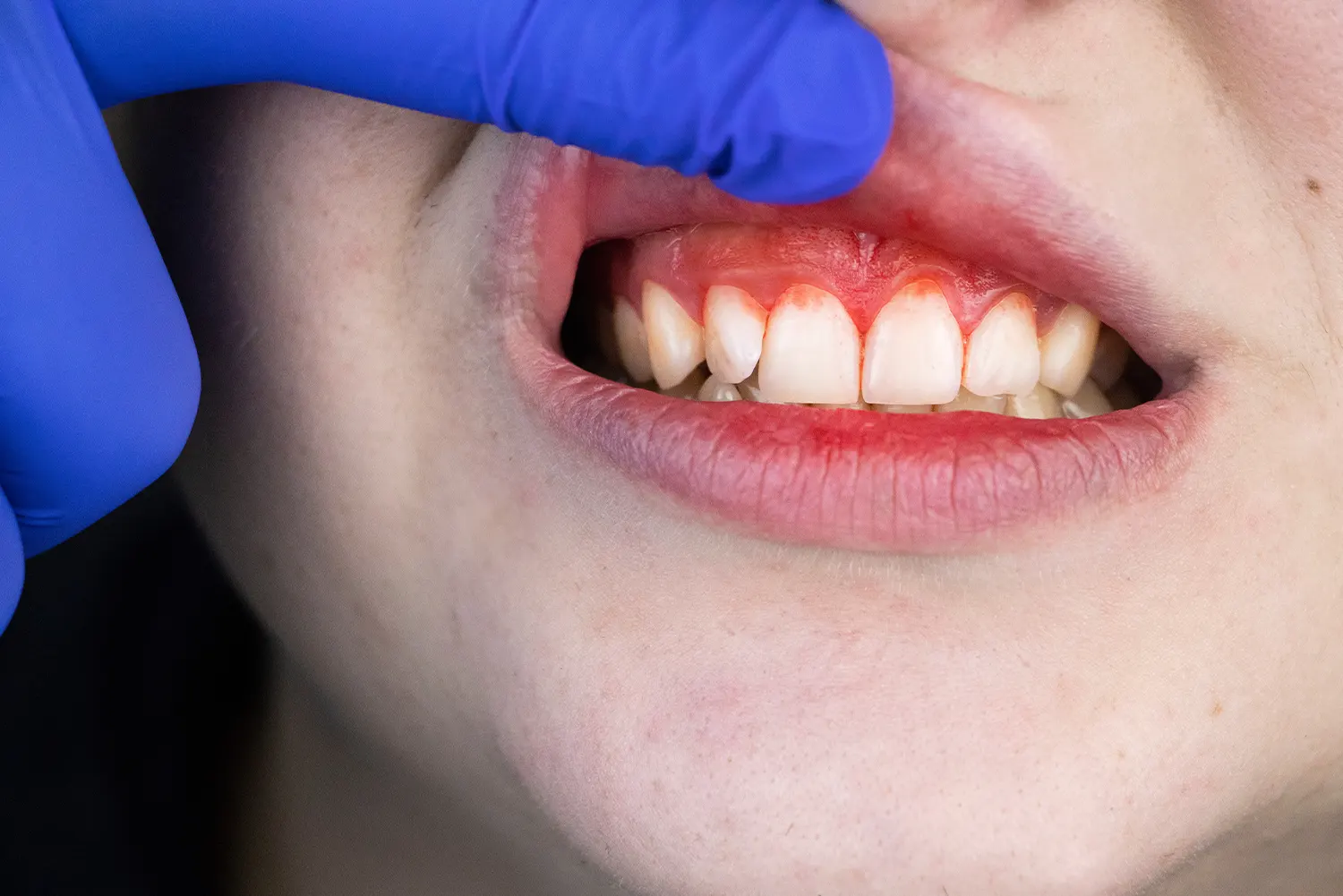 Is it Just Bleeding Gums? Understanding Periodontal Disease Warning Signs
