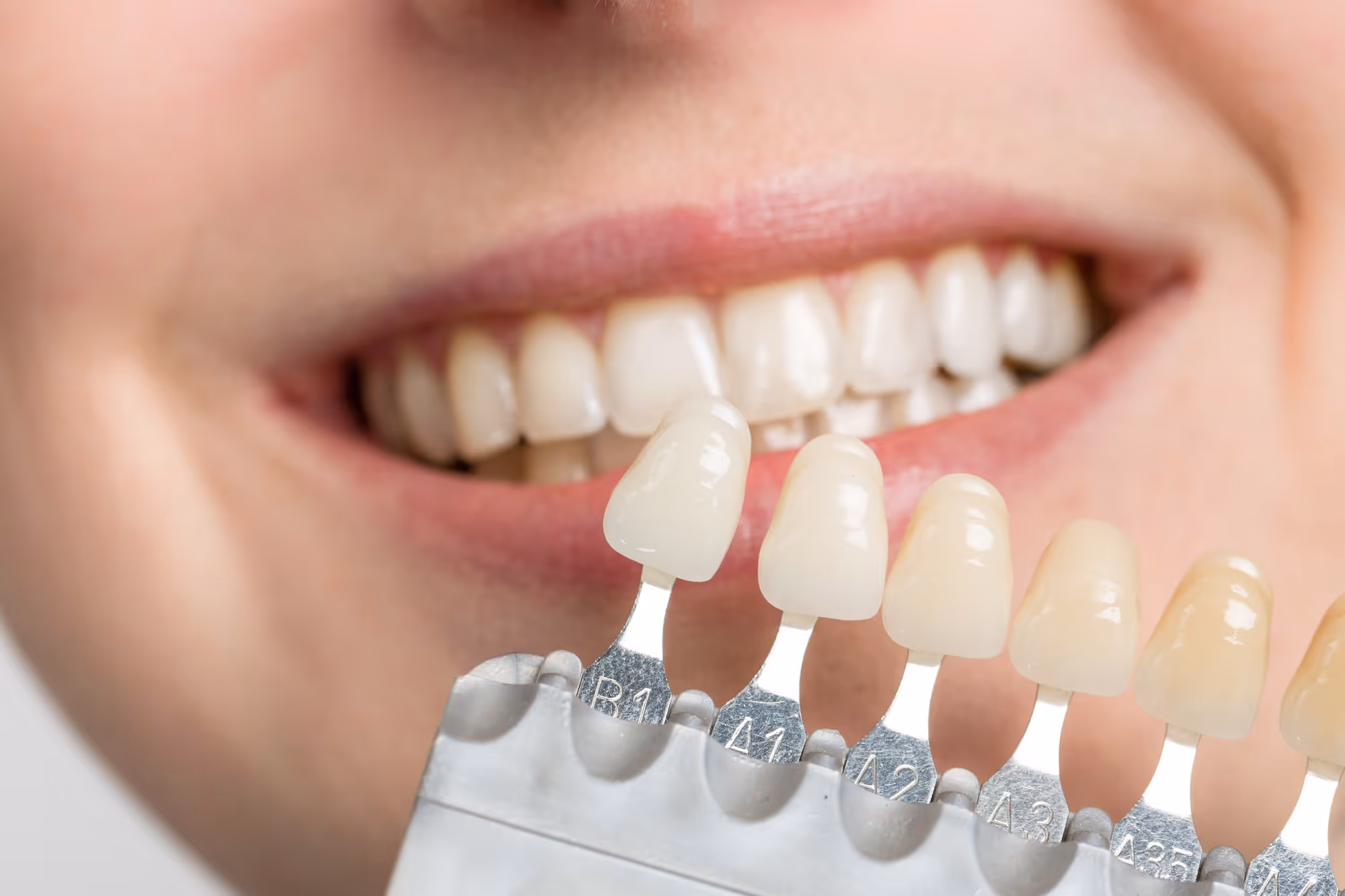 How Long Do Veneers Last? Veneer Lifespan, Caring For Veneers, And More