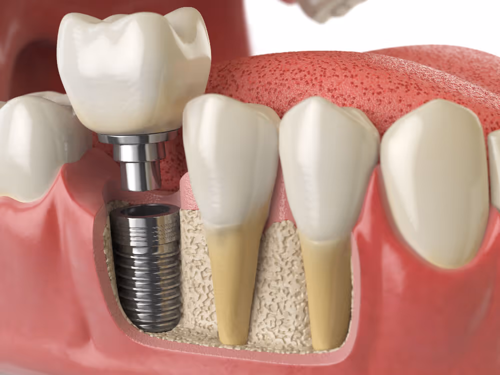 What Are The 3 Stages Of Dental Implant Treatment? 