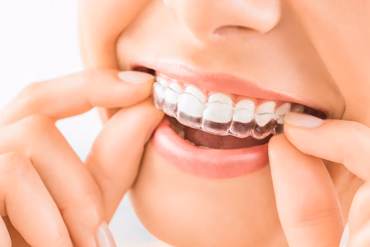 How Long Does it Take For Invisalign to work?