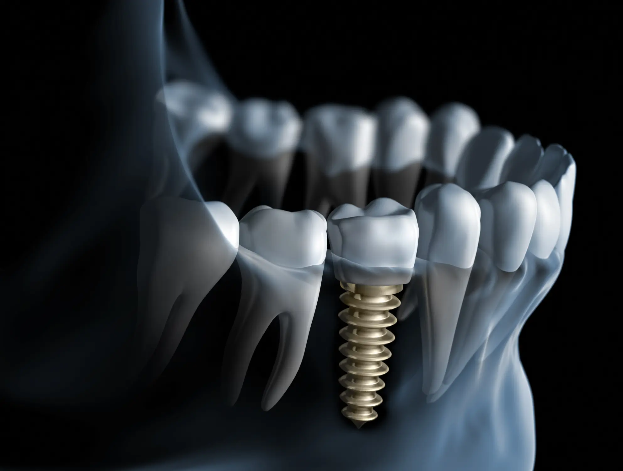 Understanding Dental Implants: A Permanent Solution for Missing Teeth