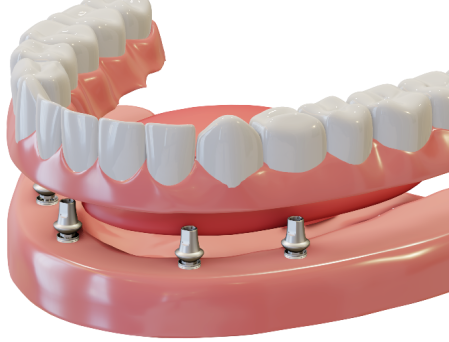 implant retained dentures
