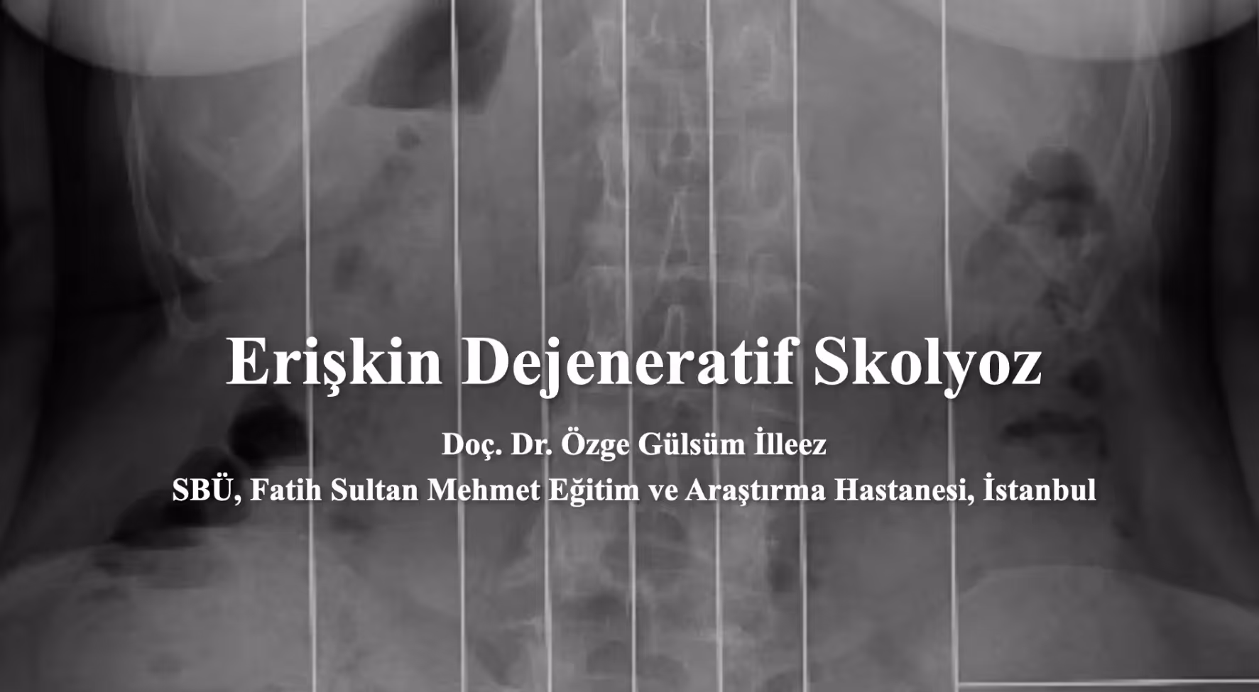 Erişkin Dejeneratif Skolyoz