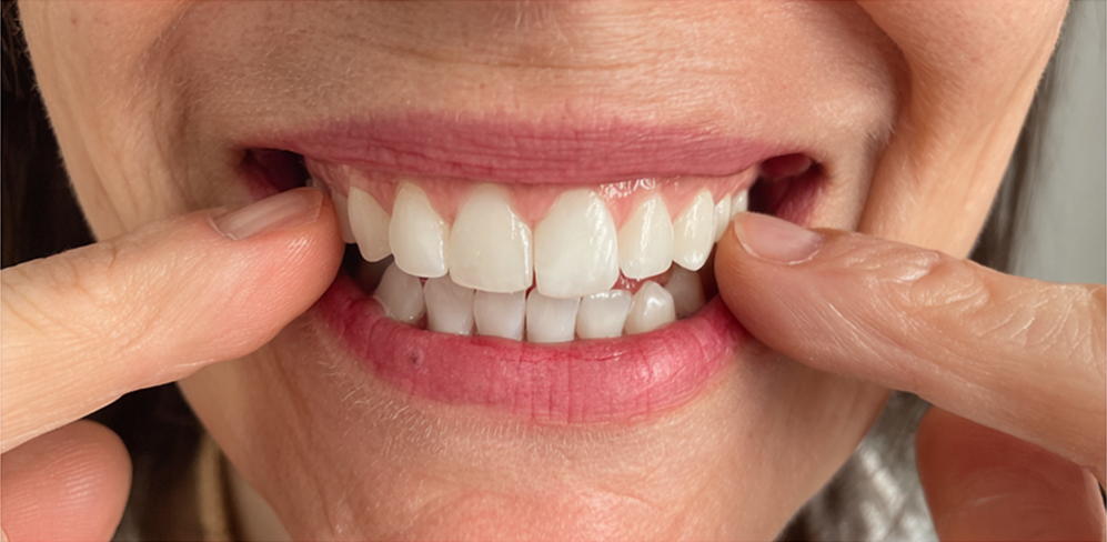 Close-up of white teeth after Wally treatment