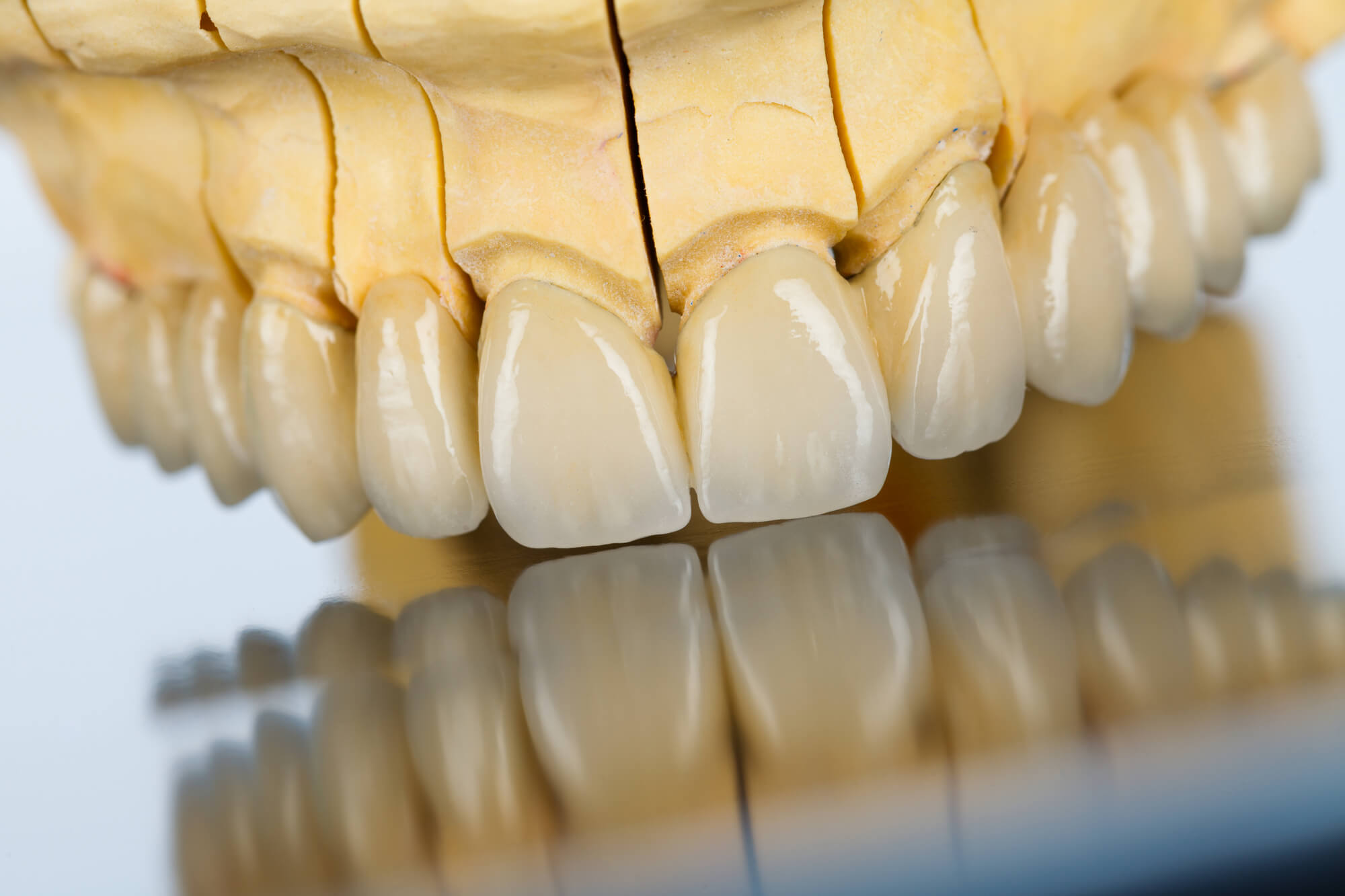 teeth model after Dental Implants Fort Lauderdale