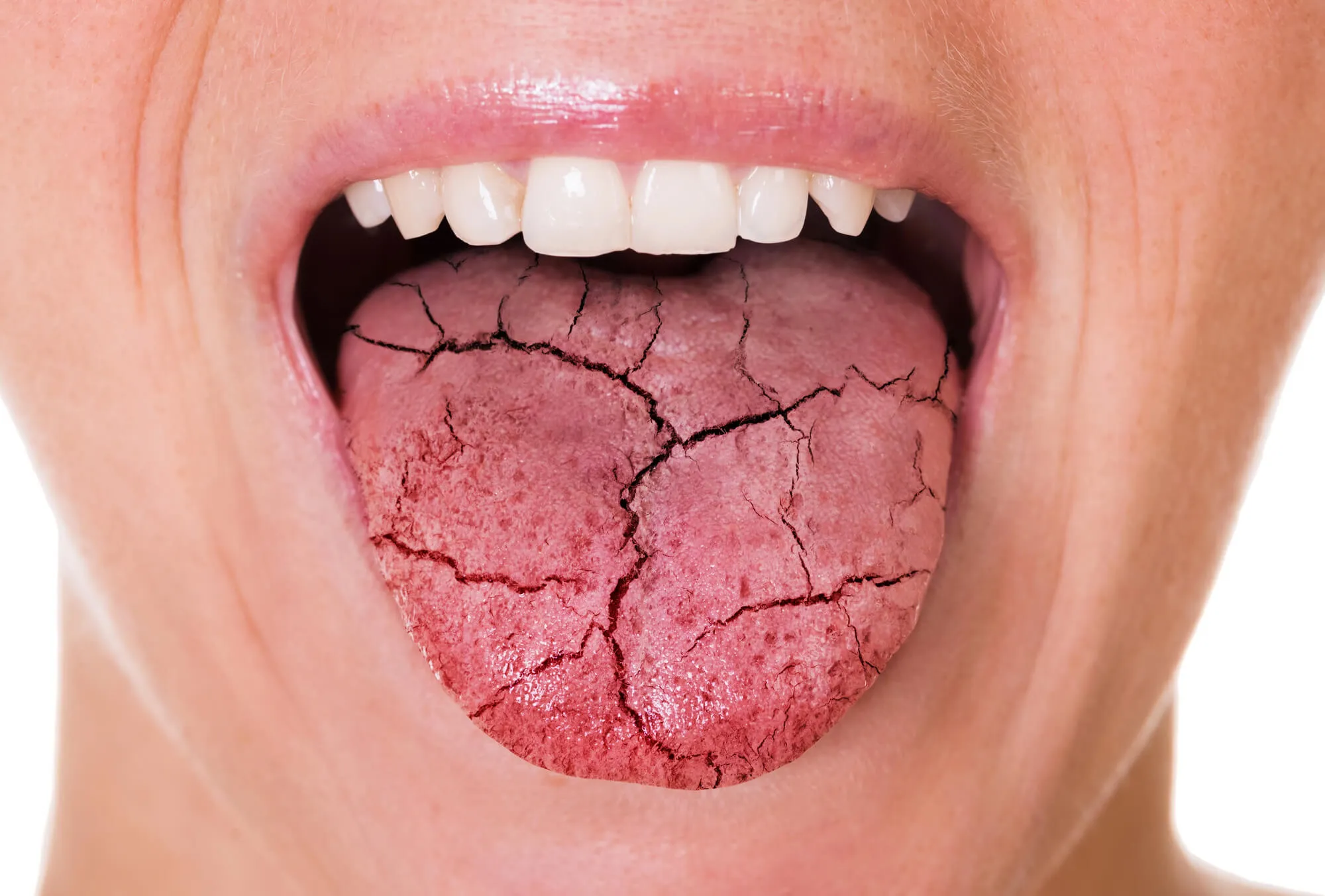 patient showing a cracked tongue to her dentist 33304 symbolizing dry mouth