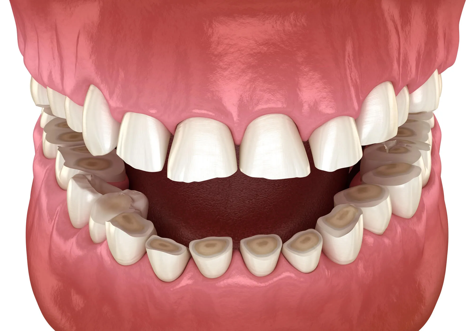 dentist wilton manors fl worn teeth illustration