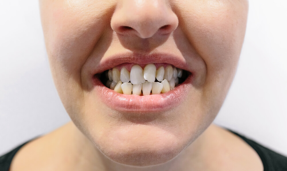 woman with crooked teeth needing a Teeth Whitening treatment in Fort Lauderdale   